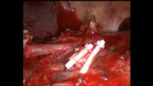 Торакоскопическая резекция левой нижней доли при раке легкого.