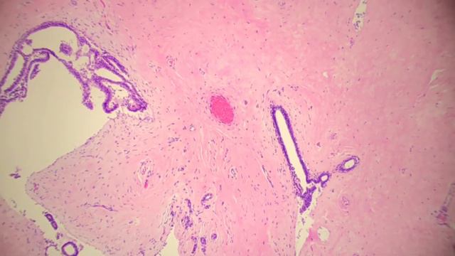 Short Review: Fibroadenoma (Breast) смотреть онлайн