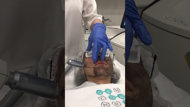 Карбоновый пилинг в клинике GEN87. Япокупаю.ру смотреть онлайн