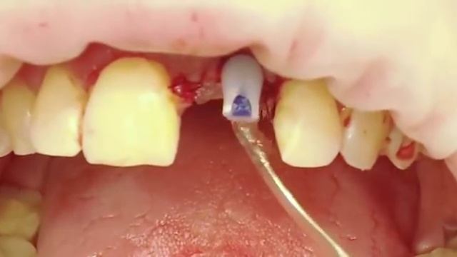 Изготовление временной коронки на имплант прямым методом смотреть онлайн