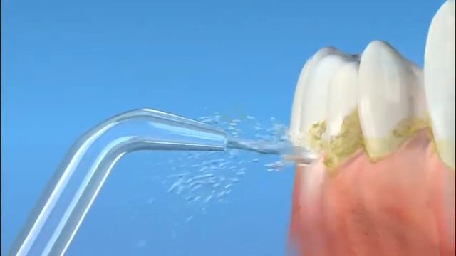 Эффективное удаление налёта с помощью ирригатора Waterpik смотреть онлайн