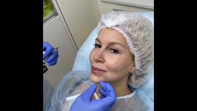 Гармонизация лица точечные инъекции гиалуроновой кислоты. Личный опыт До и после результат