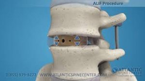 Установка межтелового кейджа и транспедикулярной фиксации