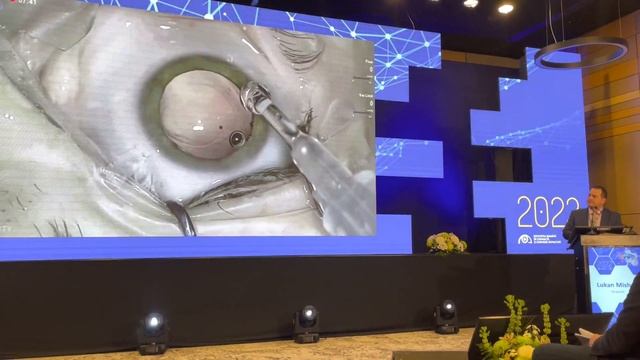 B+L Luxsmart EDOF As New Opportunity For Presbyopia Correction In Routine And Challenging Cases