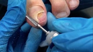 ОНИХОЛИЗИС ИЗ-ЗА ОБУВИ/ТРАВМА НОГТЯ?/ЗАЧИСТКА ОНИХОЛИЗИСА