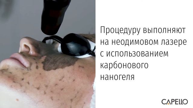 Карбоновый пилинг CAPELLO