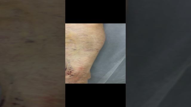 Лечение варикоза. Рецидив варикоза. Нога после операции по удалению варикоза. Флеболог Москва смотреть онлайн