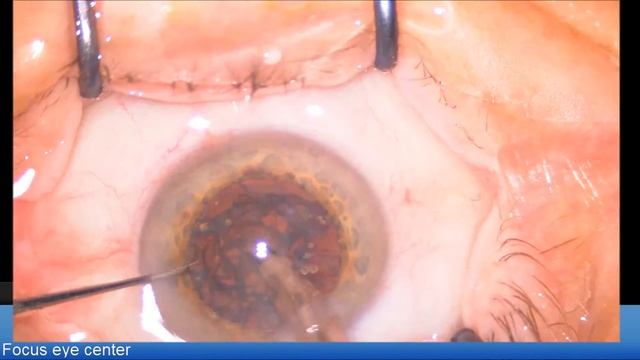 Posterior polar cataract LENTIS Comfort Lukan Mishev Live Stream смотреть онлайн