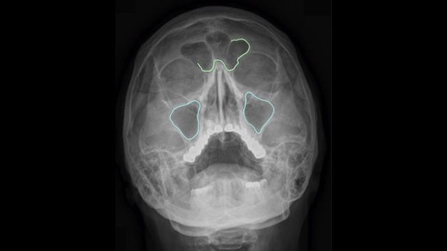 СИНУСИТ: почему вы болеете смотреть онлайн