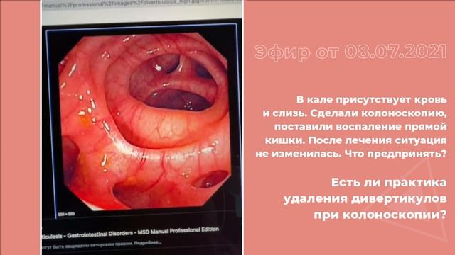 Возможно ли удаление дивертикулов при колоноскопии? смотреть онлайн