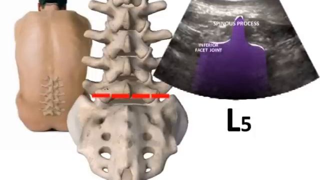 LUMBAR SPINE SONOANATOMY