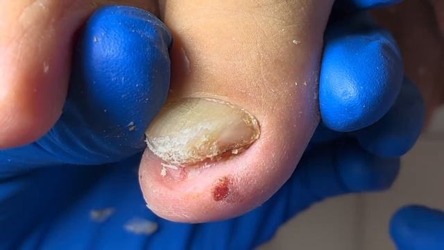 Lovely Onychomycosis Thoroughly Manicured!【Xue Yidao】