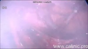 Лапароскопическая TAPP герниопластика