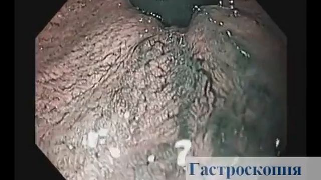 Эндоскопия смотреть онлайн