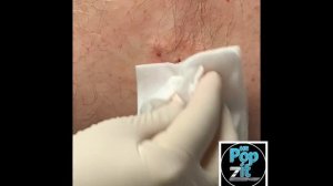 Golden nugget inflamed cyst. Cyst pop. Cyst removal. Cyst excision. MrPopZit.