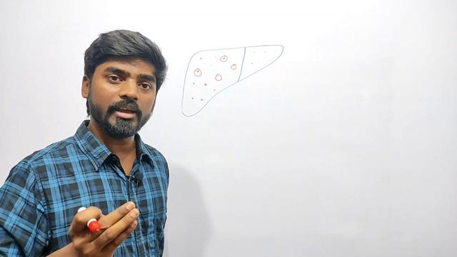 Liver Cyst (हिंदी में) || Explained by K Amitesh singh смотреть онлайн