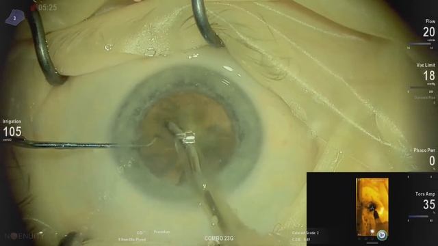 B&L LuxSmart edof Lukan Mishev live stream смотреть онлайн