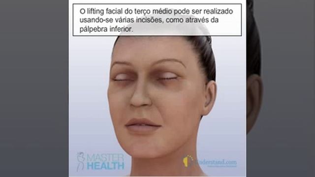 LIFTING FACIAL DO TERÇO MÉDIO, PREÇO, ANTES E DEPOIS, EM FORTALEZA, SÃO PAULO, RIO DE JANEIRO... смотреть онлайн