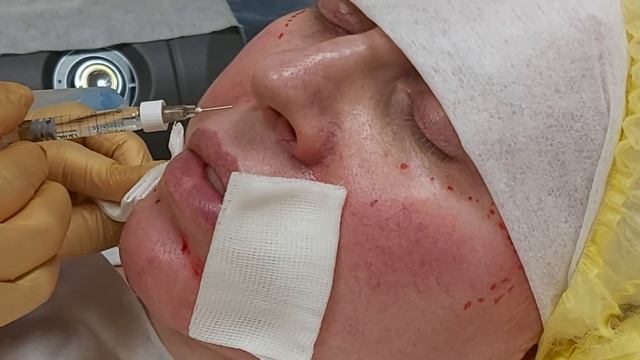 Коррекция лица филлером, заполнение морщин вокруг рта. смотреть онлайн