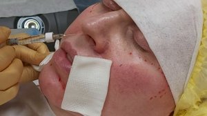 Коррекция лица филлером, заполнение морщин вокруг рта.