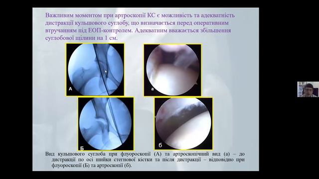 Вебінар - Рання діагностика та профілактика прогресування коксартрозу смотреть онлайн