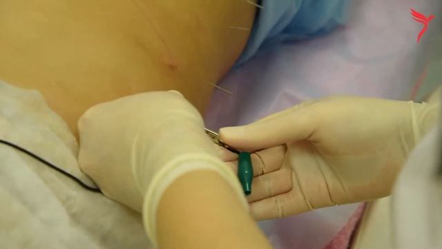 Процедура электроиглолиполиза смотреть онлайн