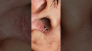 Акне. Черные точки. Вросшие волосы и прыщи. Ушная пробка и сера!