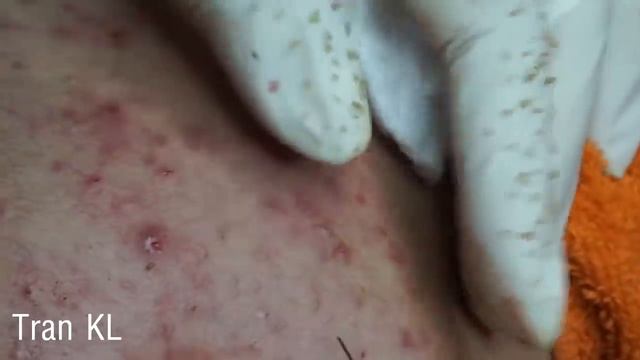 Acne Blackheads Whiteheads Removals On Face |  How To Get Rid Of Blackheads Easy Part 7