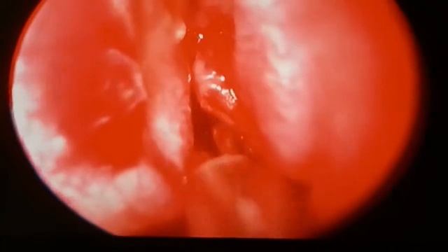 Видеоэндоскопическая гайморотомия с удалением кисты смотреть онлайн