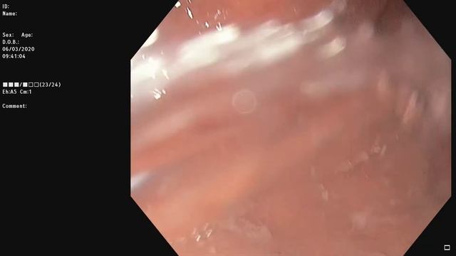 Эритематозная гастропатия. Атрофия О2. IM1, WOS+, LBC+.