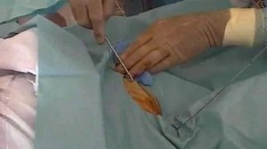 Установка катетера Life-Catch 2193