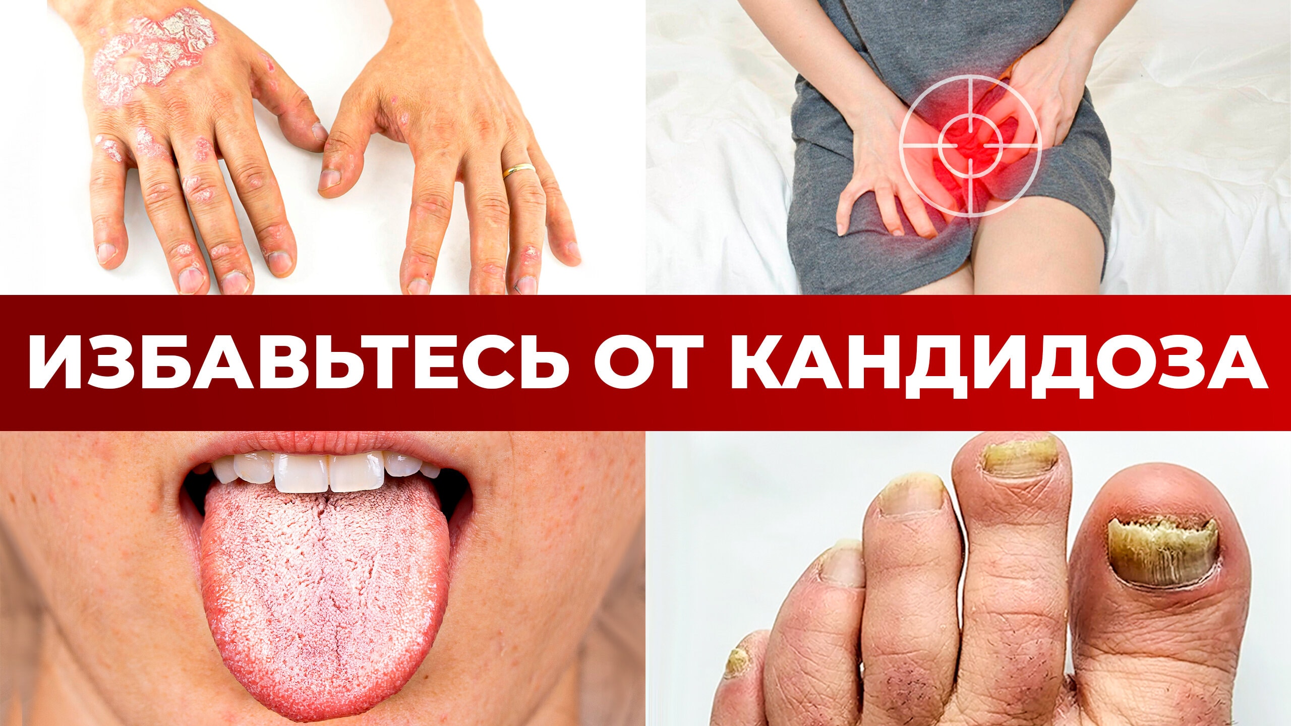 Как вылечить КАНДИДОЗ без ТАБЛЕТОК? / Первопричина кандидоза смотреть онлайн