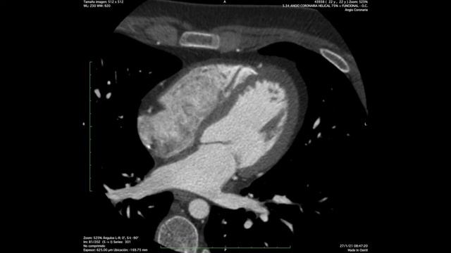 ANGIOTAC CORONARIA PARENQUIMA CARDIACO смотреть онлайн