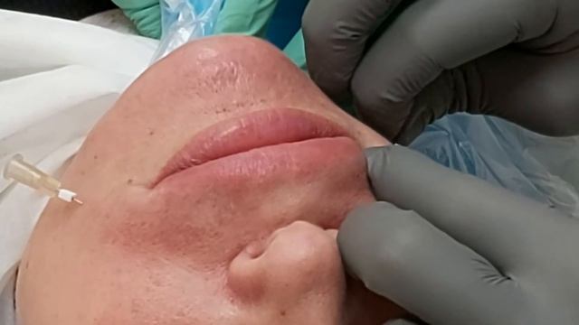 Мезонити, носогубная складка. смотреть онлайн