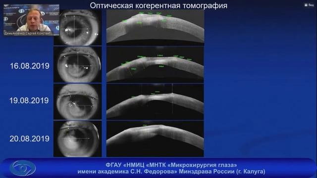 Язвы роговицы грибковой этиологии. Успехи и неудачи смотреть онлайн