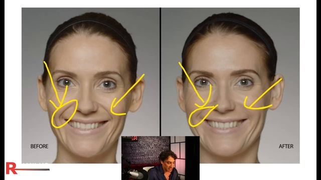 LAUGH LINE FILLERS // How to Create Beauty смотреть онлайн