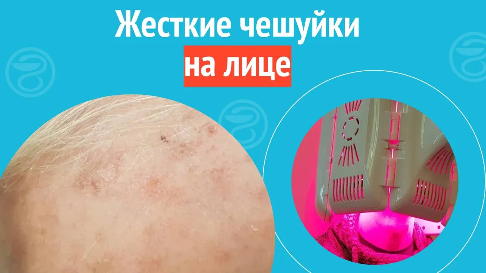 🧑🦲 Жесткие чешуйки на лице. Клинический случай №1251 смотреть онлайн