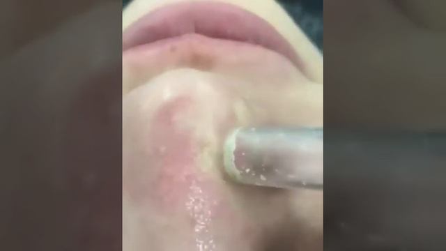 Вакуумная чистка лица ? смотреть онлайн