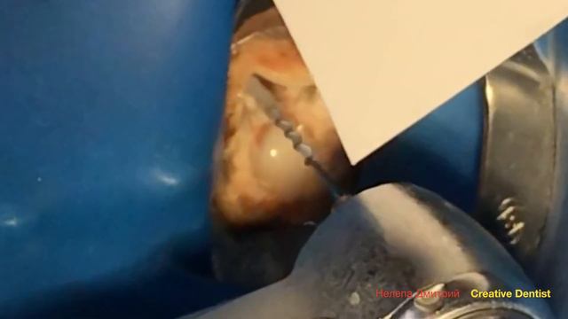 Разборная культевая вкладка / Cast Post. смотреть онлайн