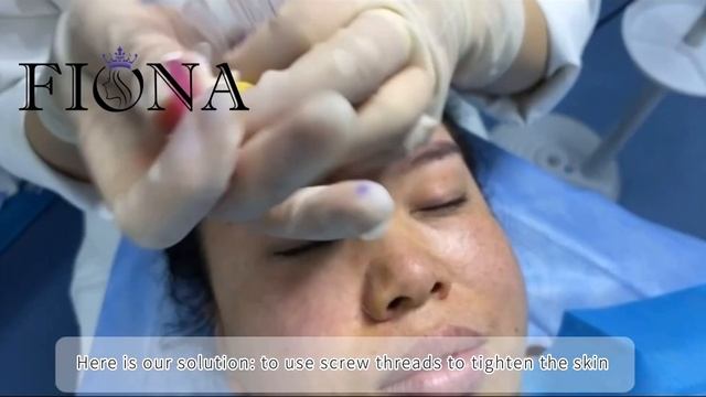 Absorbable PDO PCL PLACL Cog Lifting Thread 4D 6D 12D Molded смотреть онлайн