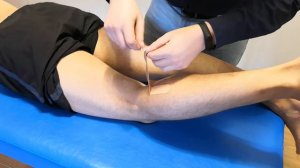 Наложение кинезио тейпа при кисте Бейкера