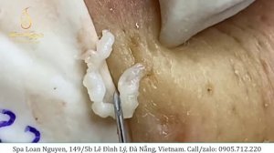Removing large cysts for boys and whiteheads extraction (233) | Loan Nguyen