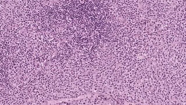 Histopathology Lymph node--Peripheral T-cell lymphoma, unspe смотреть онлайн
