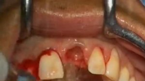 Удаление зуба ультразвуковой насадкой EX1