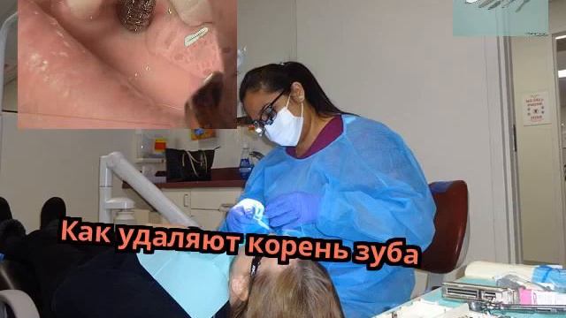 Как удаляют корень зуба смотреть онлайн