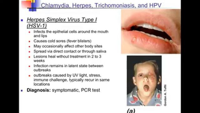 Human microbe interactions part 2 STDs chylamida, herpes, HPV смотреть онлайн