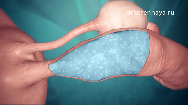 Бесплодие. Лапароскопия в лечении женского бесплодия смотреть онлайн