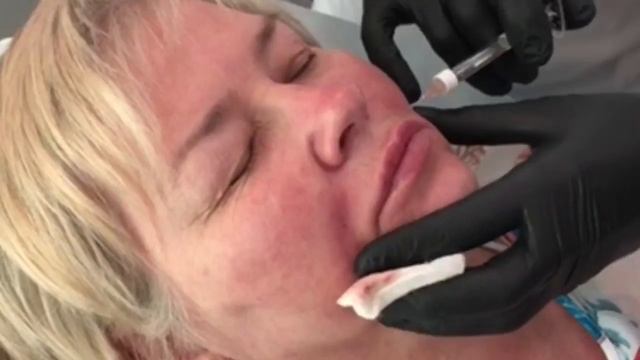 Носогубные складки смотреть онлайн