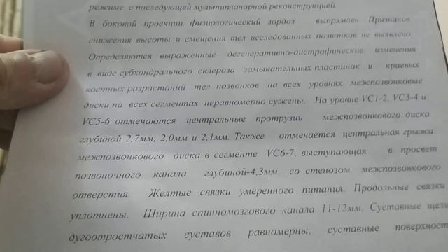 Грыжа диска шейного отдела позвоночника.Видеосьемка больной после лечения смотреть онлайн