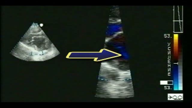 Тромб в левом предсердии сердца, сочетанный митральный порок.